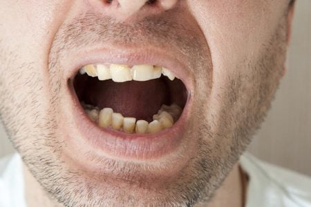 Loose Tooth Pain: Top Home Remedies for Loose Tooth Pain Relief
