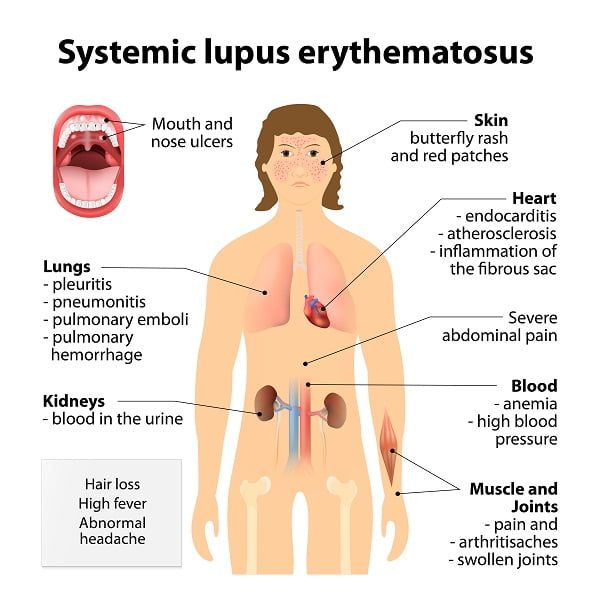 Systemic lupus erythematosus