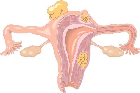 Postmenopausal Ovarian Cyst and Malignant Ovarian Cysts