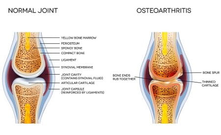 What Are the Causes and Risk Factors of Osteoarthritis?