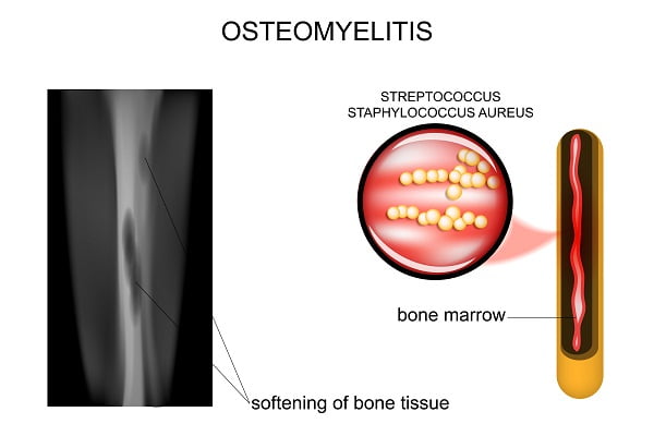 What is Osteomyelitis (Bone Infection)