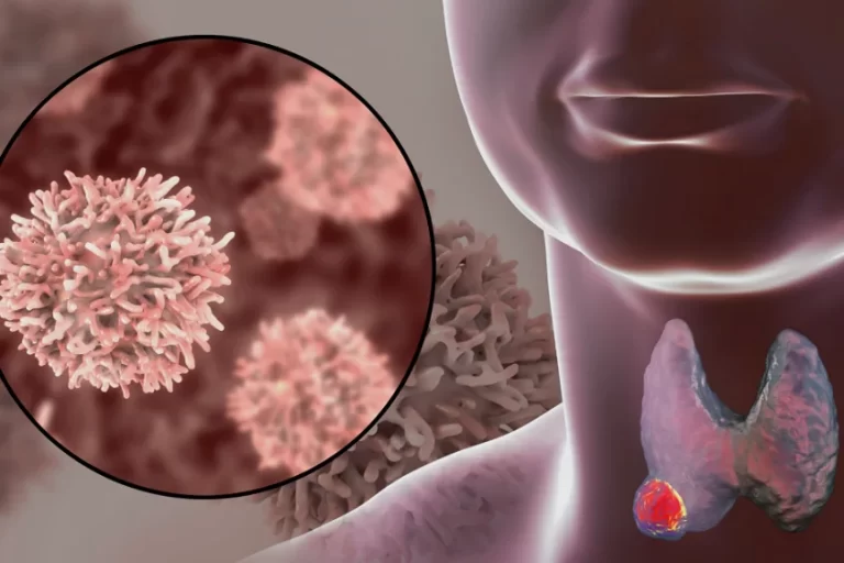 General Overview of Thyroid Cancer