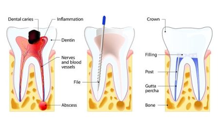 How Are Dental Cavities Treated?