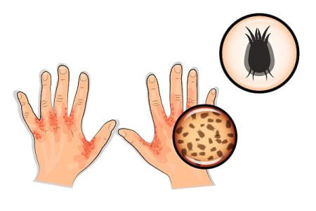 Scabies Mite: Can Scabies Mites be Seen?