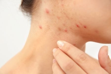 Scabies Rash: What Does Scabies Look Like On Your Skin?