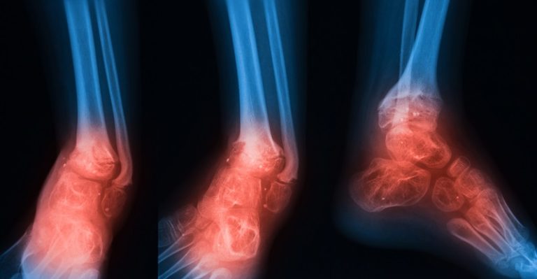 How Serious is Osteomyelitis?