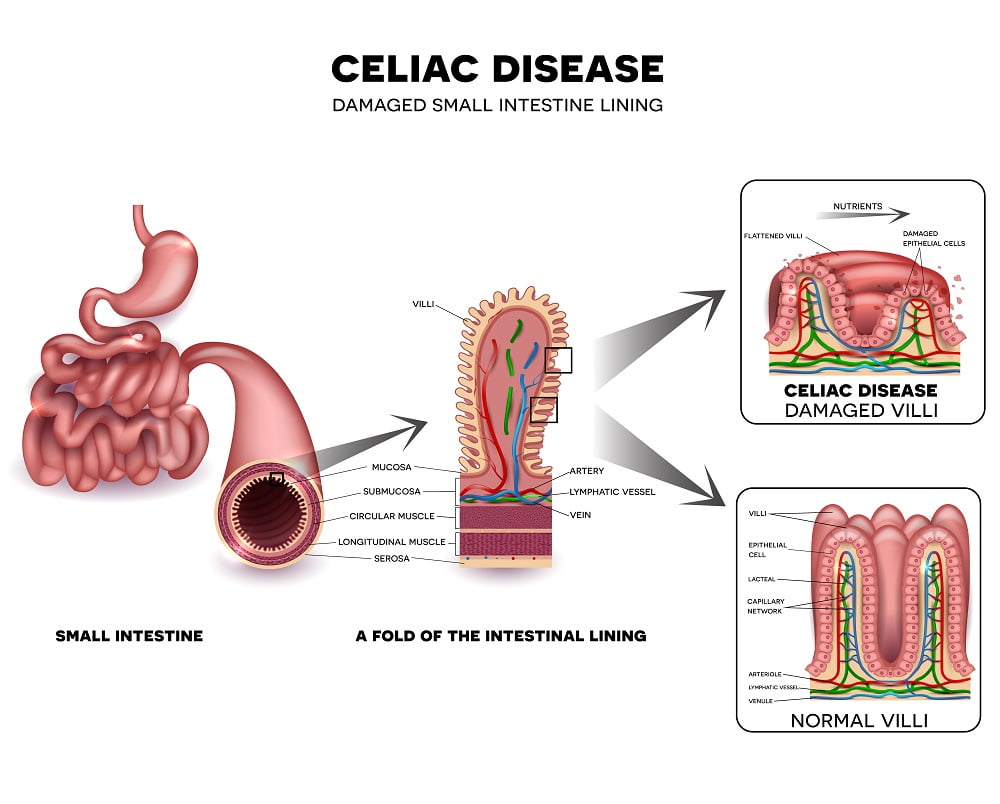 celiac disease damaged small intestine lining