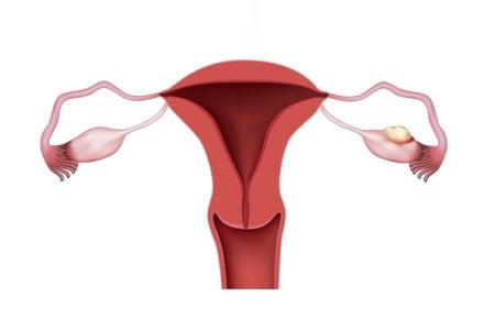 Stage 4 Ovarian Cancer