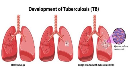 Causes Tuberculosis (TB) and Risk Factors for Tuberculosis