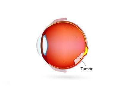 Tumor Behind Eye