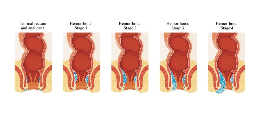 Stages of hemorrhoids