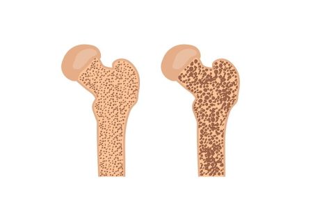 What You Should Know About Osteoporosis
