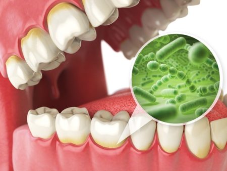 What Causes Tooth Decay?