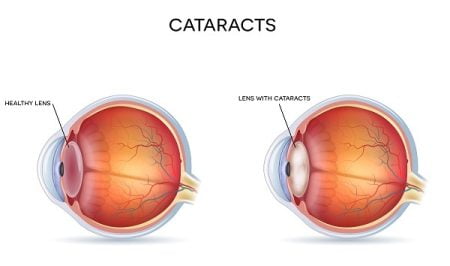 What Is a Cataract