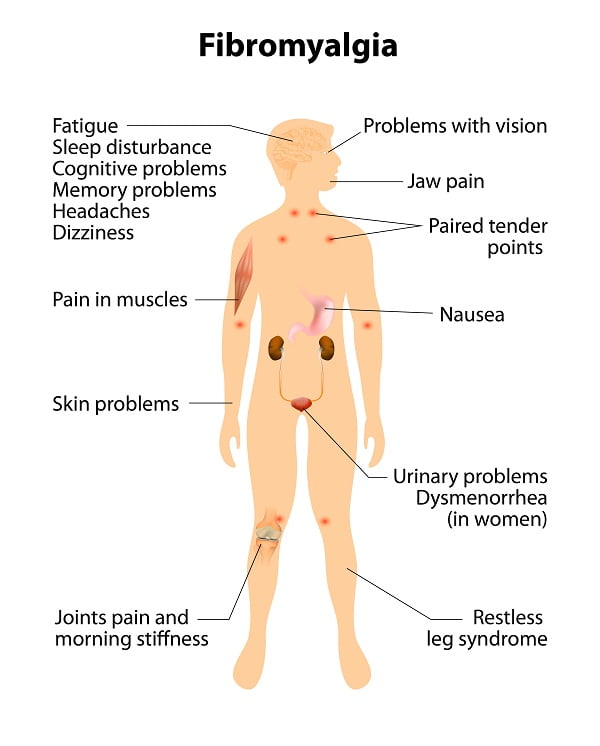 What is fibromyalgia?