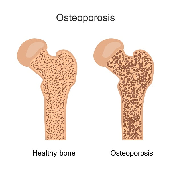 What is osteoporosis?