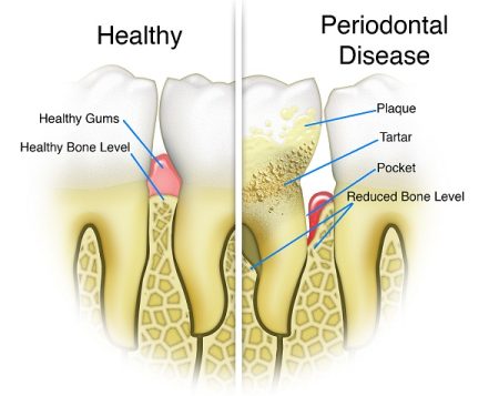 What Is Periodontal Disease (Gum Disease)