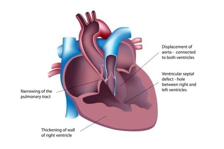 What is ventricular septal defect (VSD)