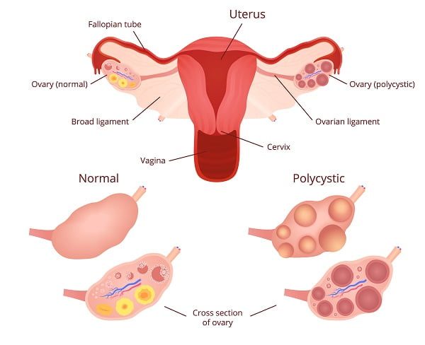 How Is Endometriosis Diagnosed?