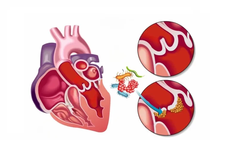 Dermatologic Manifestations of Infective Endocarditis