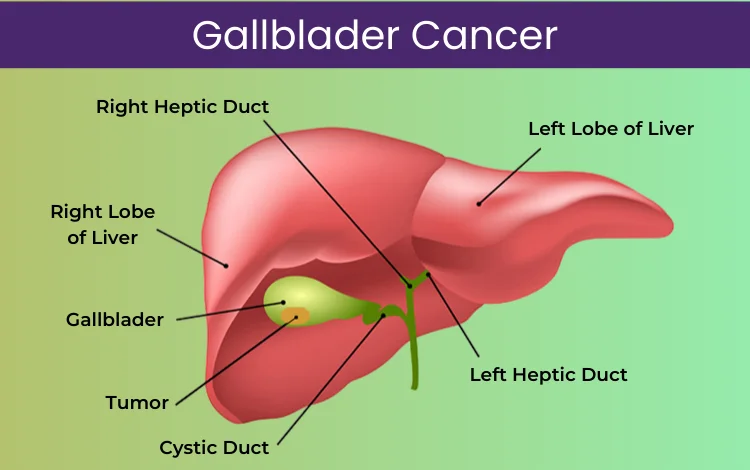 Gallblader Cancer