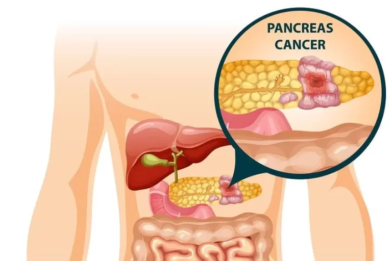 Borderline Resectable Pancreatic Cancer