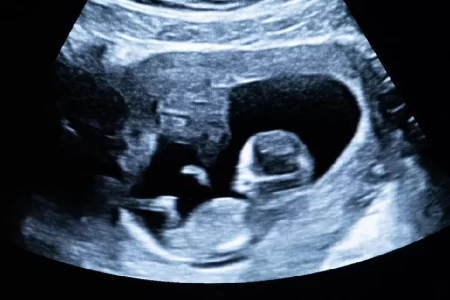 Fetal VSD Ultrasound