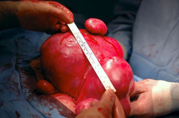 human uterus with fibroids