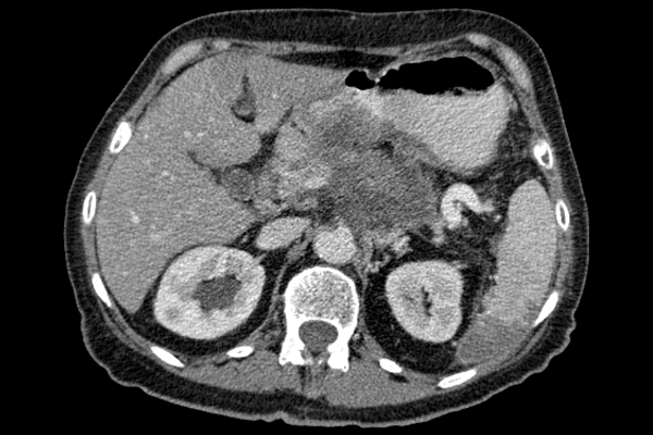 Computed Tomography (CT) Scan for Pancreatic Cancer