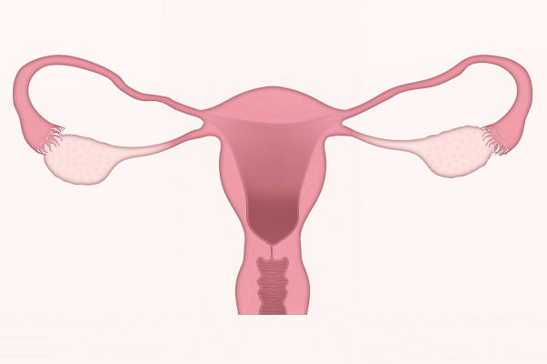 Uterine Fibroids and Risk of Cancer