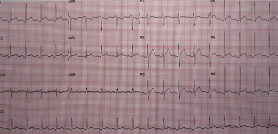 Typical ECG of a pericarditis patient