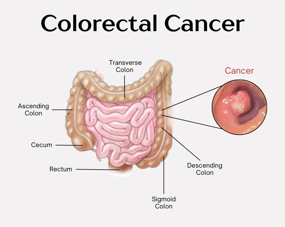 Colorectal Cancer