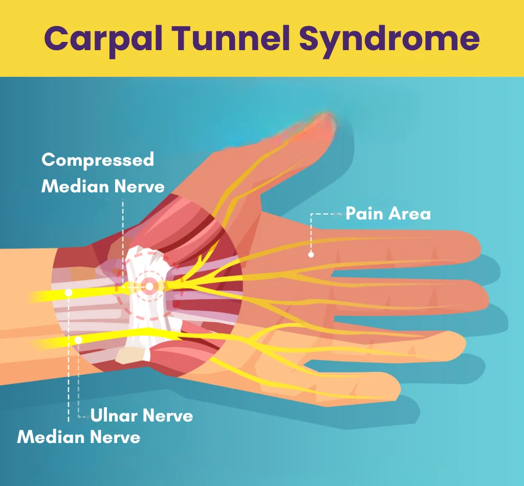 Carpal Tunnel Syndrome