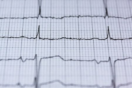 What Are the Different Types of Arrhythmias?