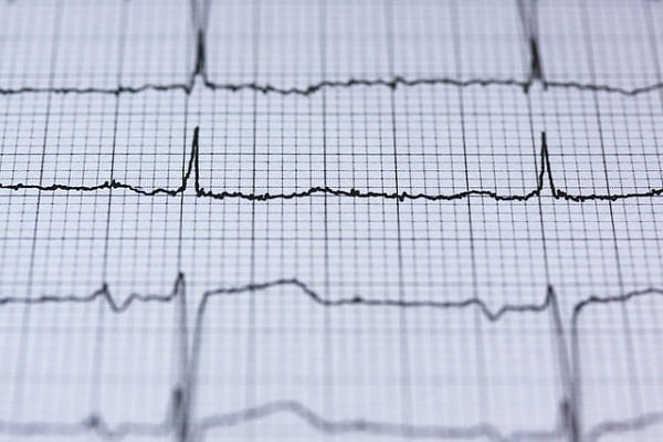 What Are the Different Types of Arrhythmias?