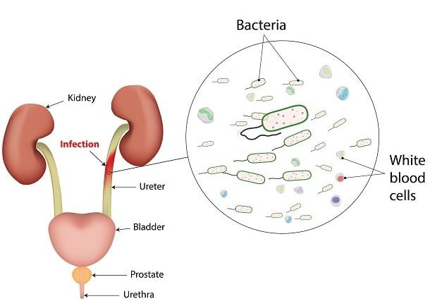 General Overview of Urinary Tract Infection (UTI)