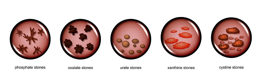 Actual kidney stone size chart in mm - kotipictures