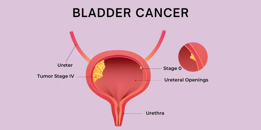 Bladder Cancer