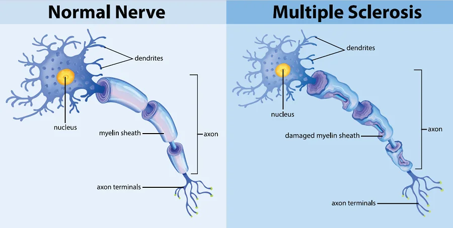 Multiple Sclerosis