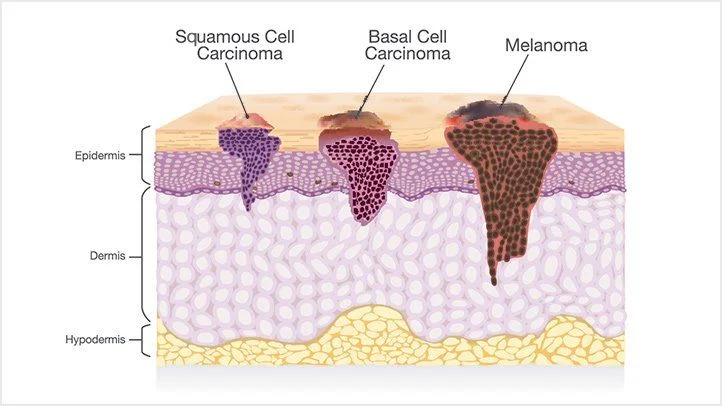 Types of Skin Cancer