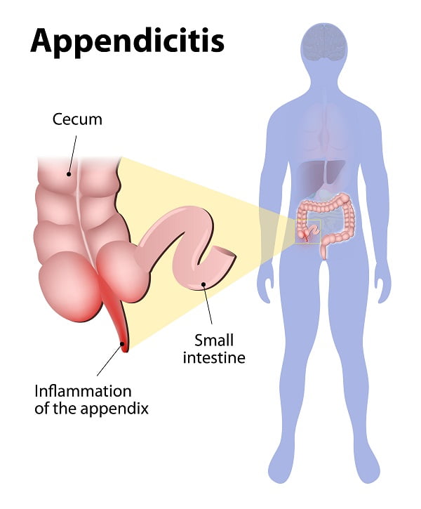 Appendicitis Symptoms Causes Diagnosis Treatments Complications Surgery