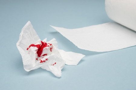 Bleeding Hemorrhoids (Piles): Why Do Hemorrhoids Bleed for Many Weeks?