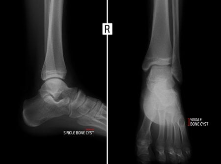 Bone Cyst on Foot or Toe or Ankle