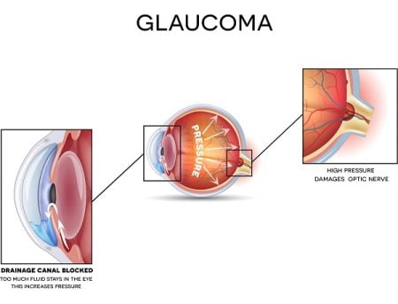 What Are the Causes of Glaucoma?