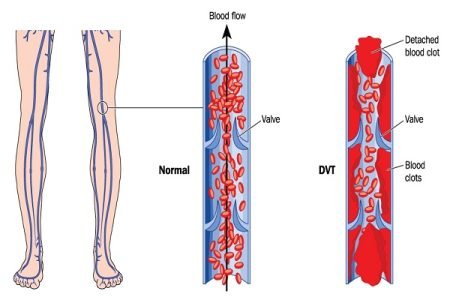 Deep Vein Thrombosis Leg Pain (Blood Clot in Leg)