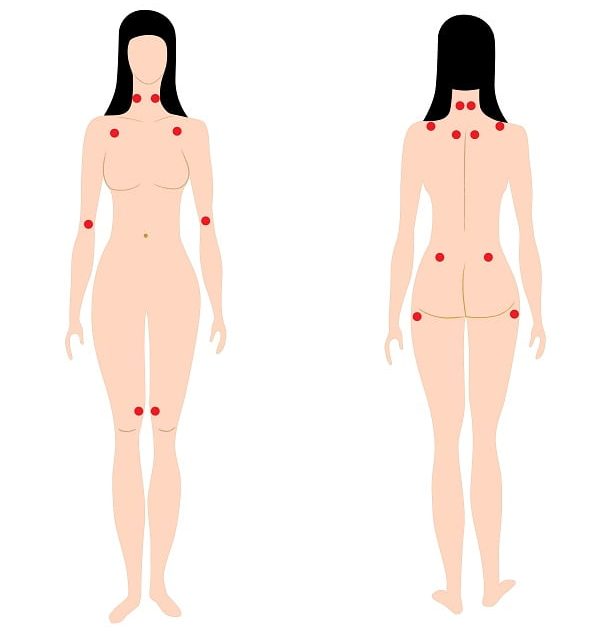Locating Fibromyalgia Tender Points or Pain Points?