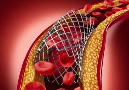 How Is Coronary Heart Disease Treated?