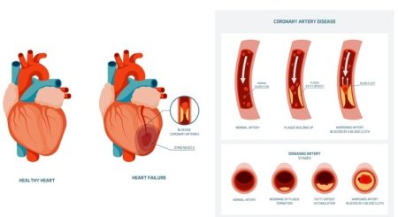 How Is Coronary Heart Disease Diagnosed?