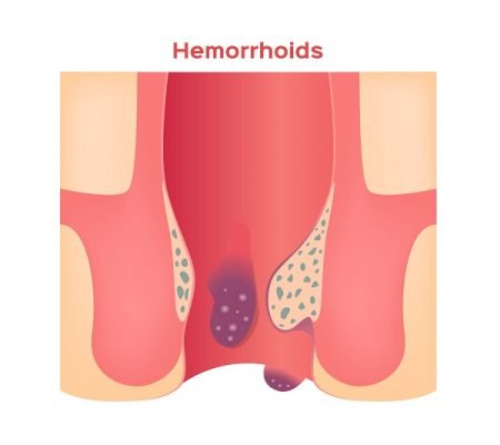 How Much Time Hemorrhoids Take to Heal?