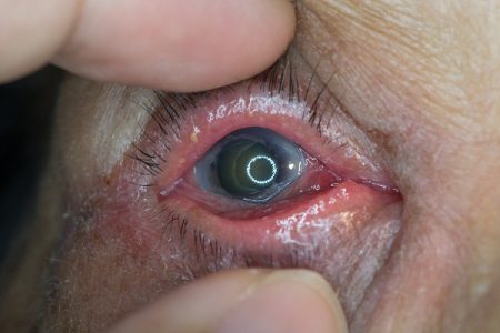 Living With Glaucoma